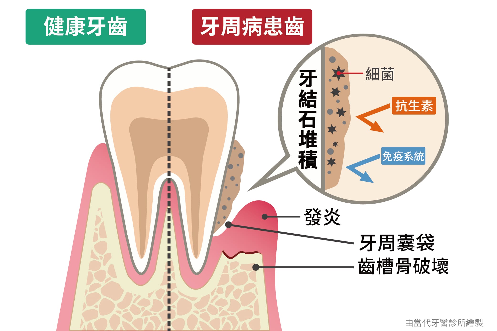 牙龈炎和牙周炎有什么区别_深圳爱康健口腔医院