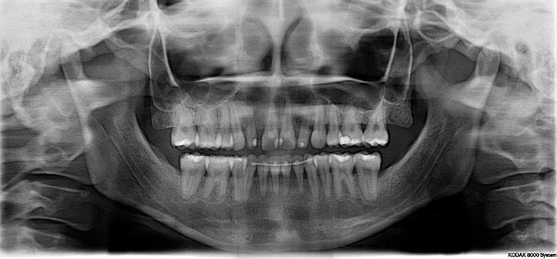 图示:miss wu的环口全景x光片,牙齿有蛀牙,补牙变色,牙缝大,比例不佳