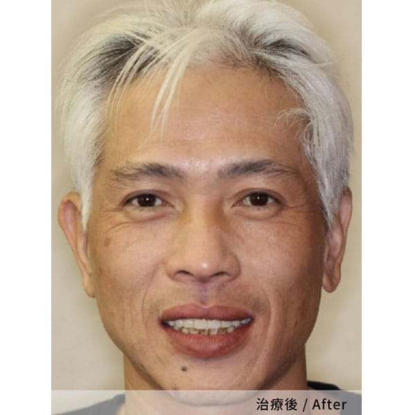 【全口重建】廖先收 / Dr.梁嘉元