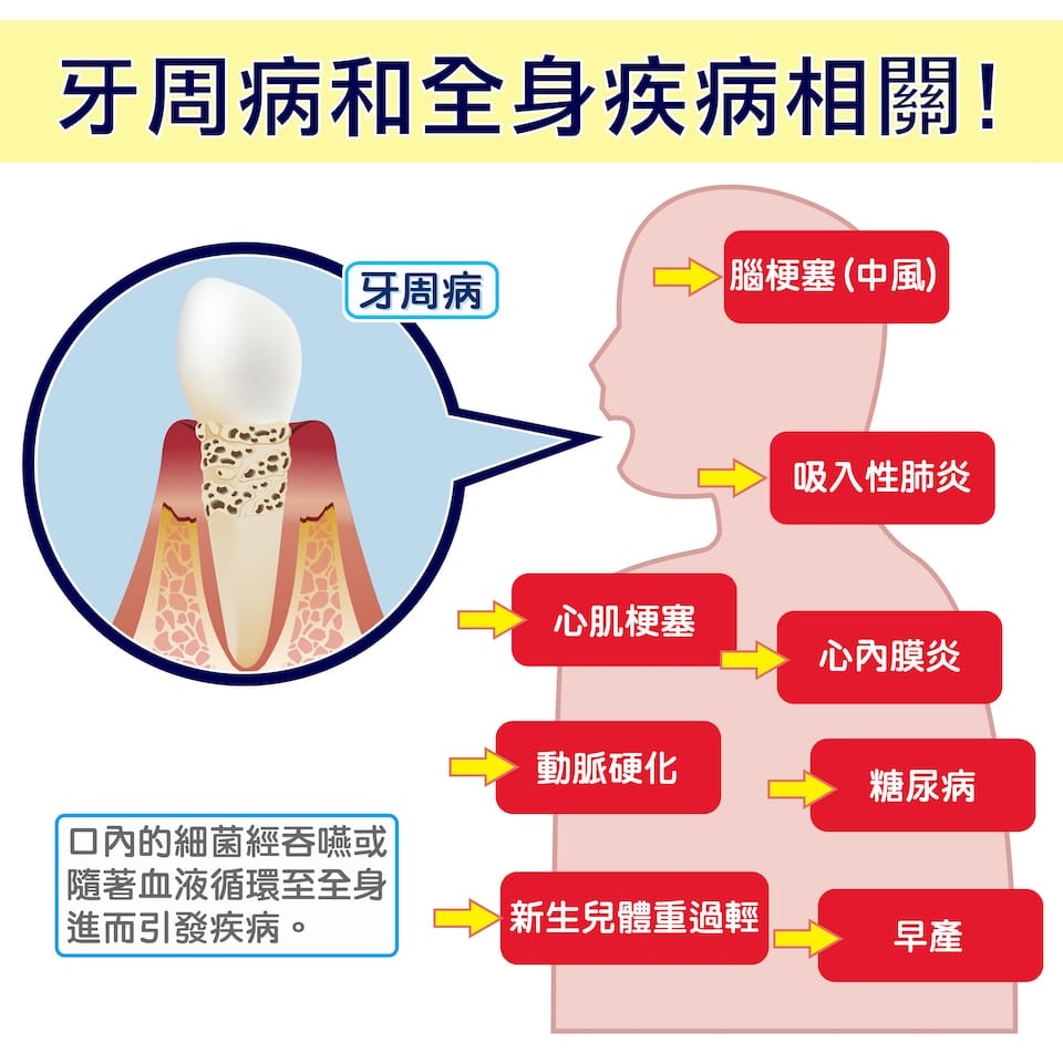 【牙科小學堂】牙周病莫輕忽，不及早治療恐影響全身健康！